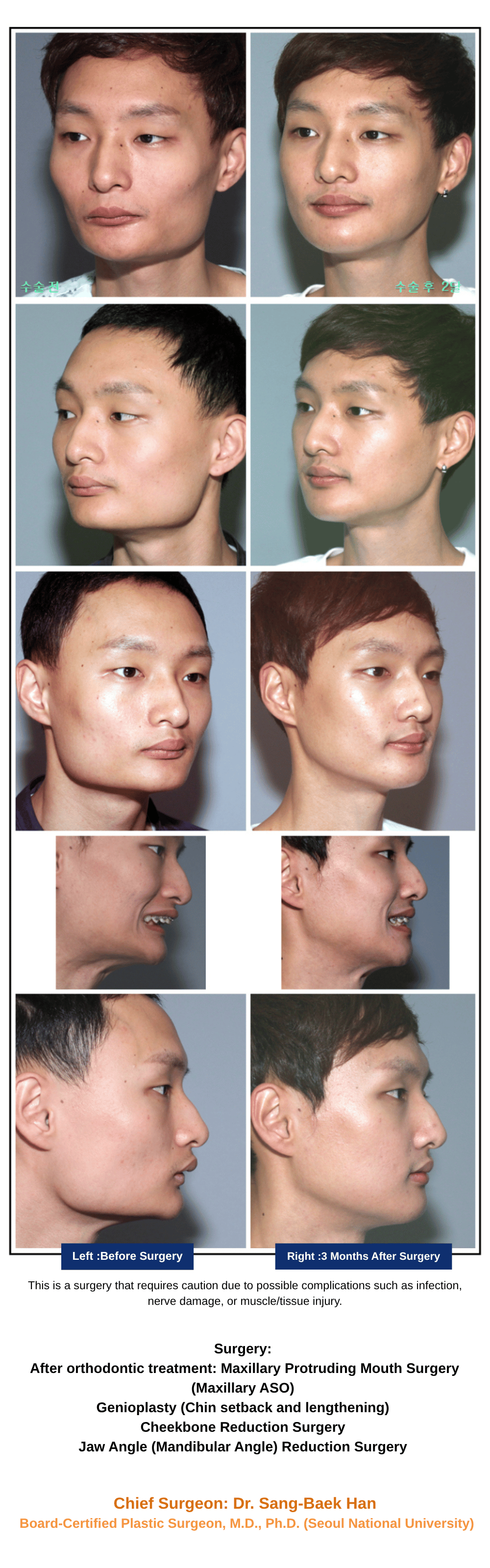 VXil Lifting + Double Chin Liposuction