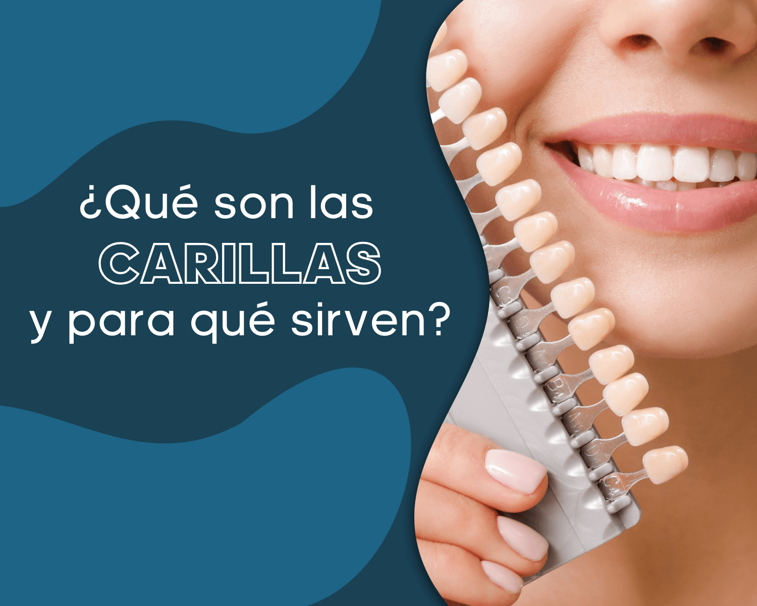 ¿Qué Son Las Carillas Dentales Y Para Qué Sirven?