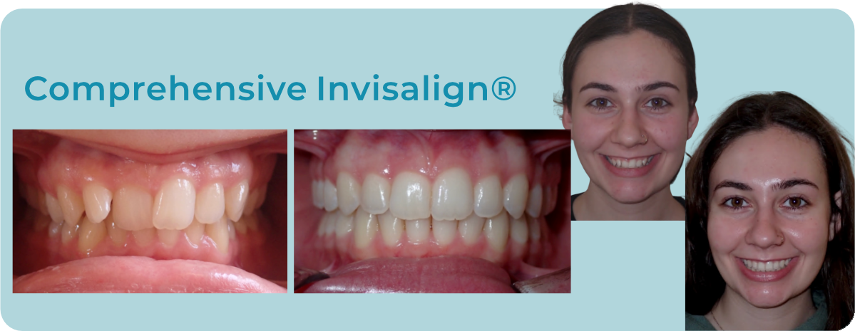 Before and after comparison of teeth straightened by Comprehensive Invisalign, showing a smiling person.