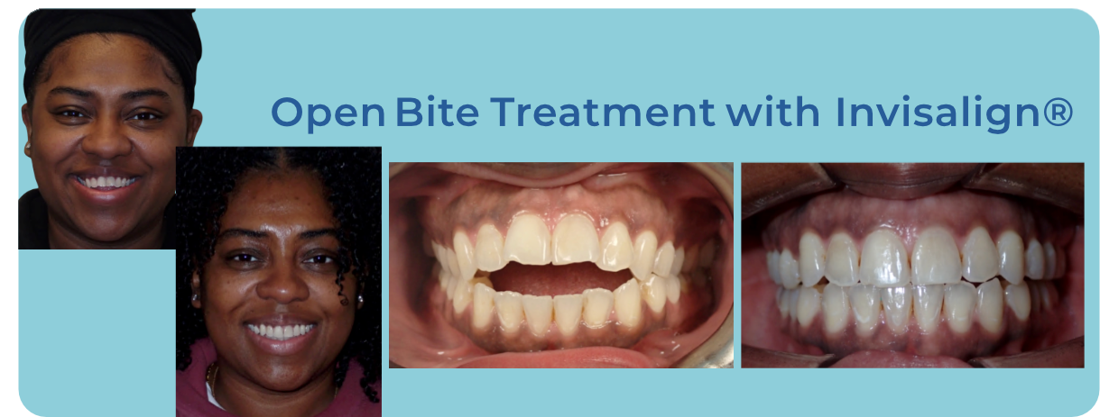 Before and after photos showing Invisalign treatment for an open bite, featuring a person smiling.