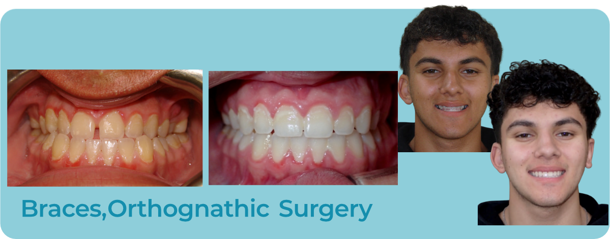Before and after photos of teeth and a person's smile, showing results of braces and orthognathic surgery.