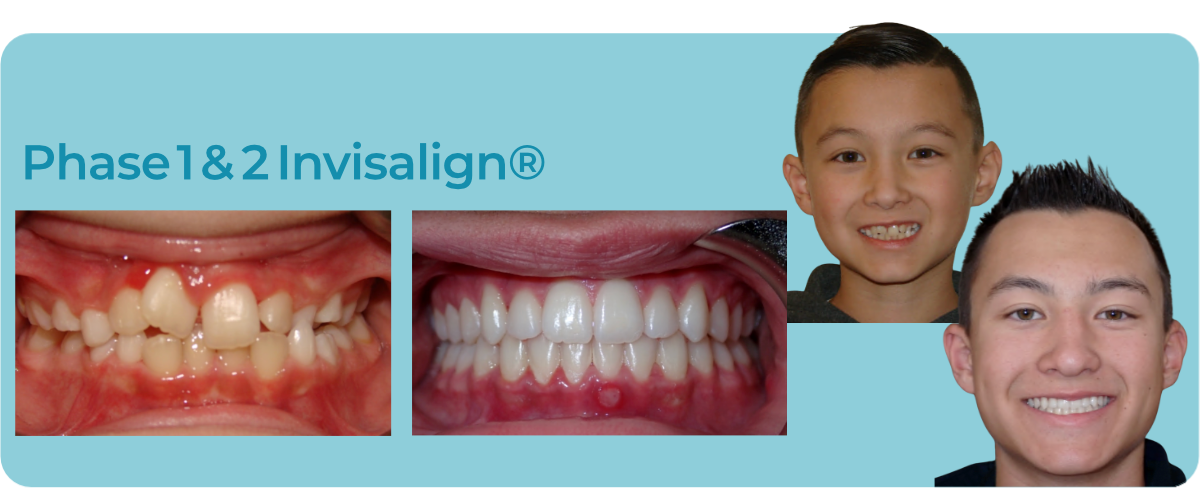 Before and after comparison of teeth straightened using Invisalign, showing a smiling person at different life stages.