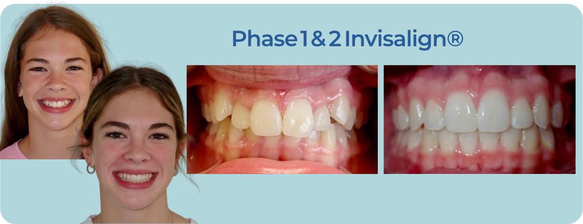 Before and after photos showing a patient's smile transformation through Phase 1 and 2 Invisalign clear aligners.