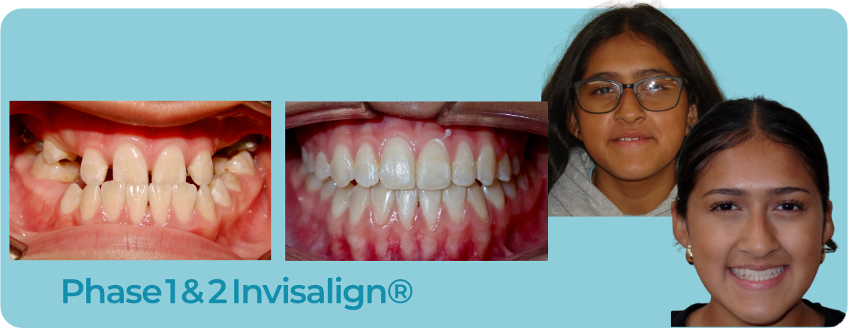 A before and after comparison of a patient’s teeth and smile after Invisalign treatment, with text reading Phase 1&2.