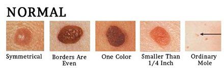 Mohs Skin Cancer 1