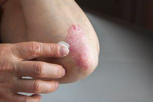 Psoriasis on elbow