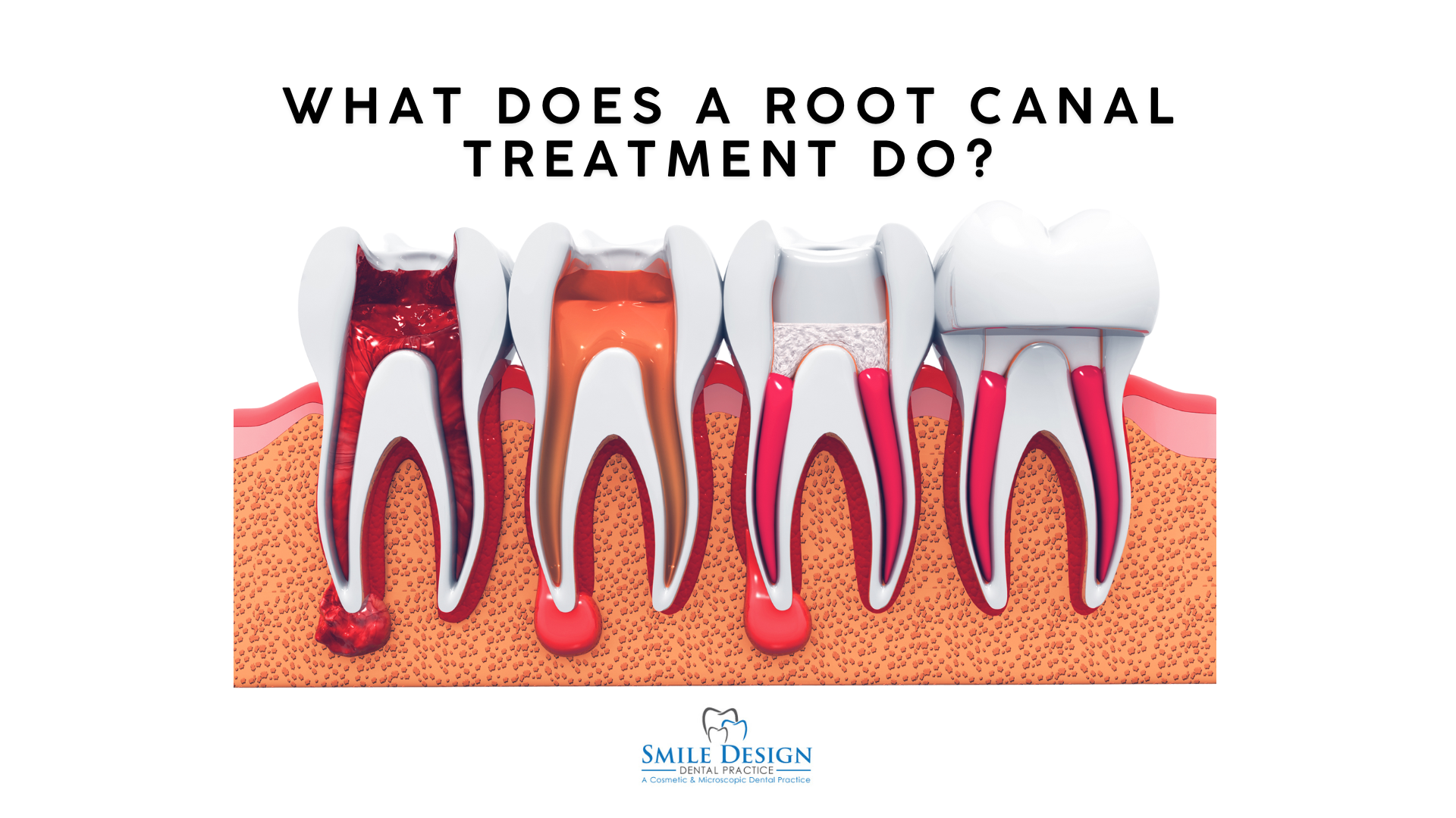 What Is Root Canal Treatment and What Does It Do?