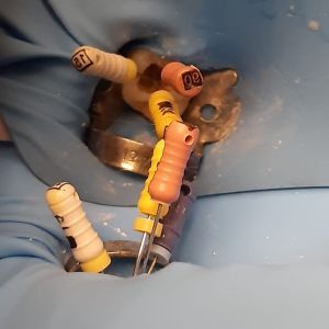 lime endodontiche e diga