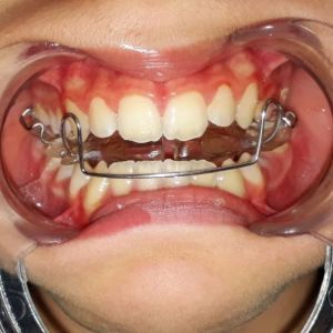ortodonzia mobile, ortodonzia rimovibile, ortodonzia bambini, logopedia, puntamento linguale, deglutizione atipica, dislalia,  dentista afragola, dentista afragola Fico