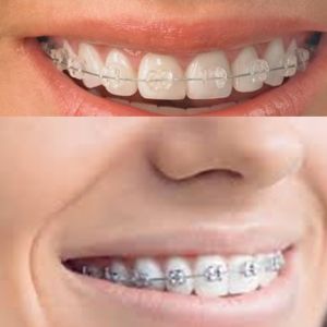 Link per saperne di più sull'orotodonzia fissa: si vedono i brackets (comunemente attacchi, volgarmente stelline) montati; si notano sia i brackets di ceramica Fascination2 per una ortodonzia estetica sia Bracket d'acciaio per la ortodonzia fissa tradizionale.