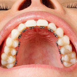 Ortodonzia linguale: allineamento dentale mediante l'uso di bracket o stelline applicate sulla superficie linguale dei denti.