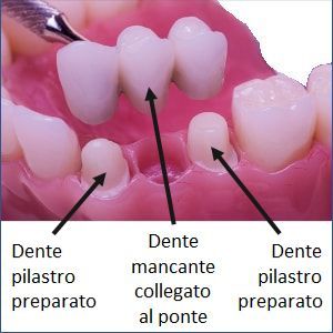 Ponte, protesi a ponte, denti ceramica, protesi fissa, oro-ceramica, zirconia, disilicato