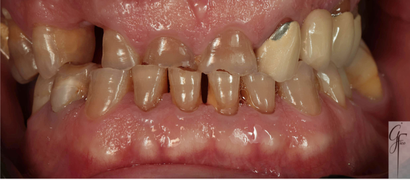Denti consumati da bruxismo e malocclusione – studio dentistico Afragola