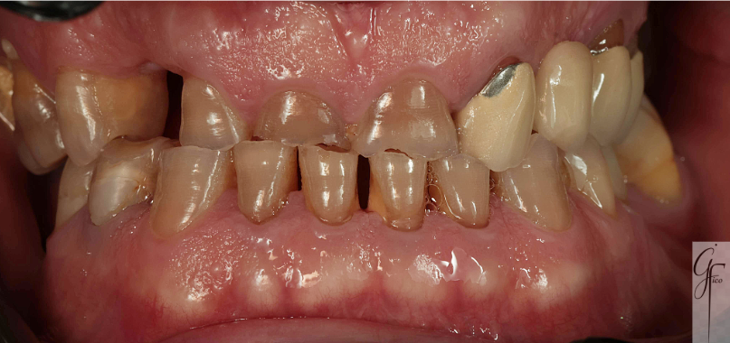 Perdita della dimensione verticale causata da bruxismo e denti consumati – dentista Afragola
