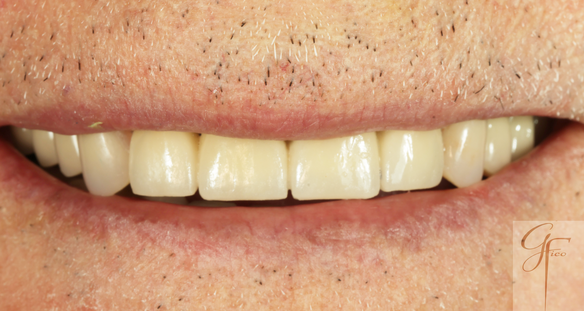 Risultato estetico  di una protesi combinata fissa su paziente ASA II ad Afragola - Dentisti Fico