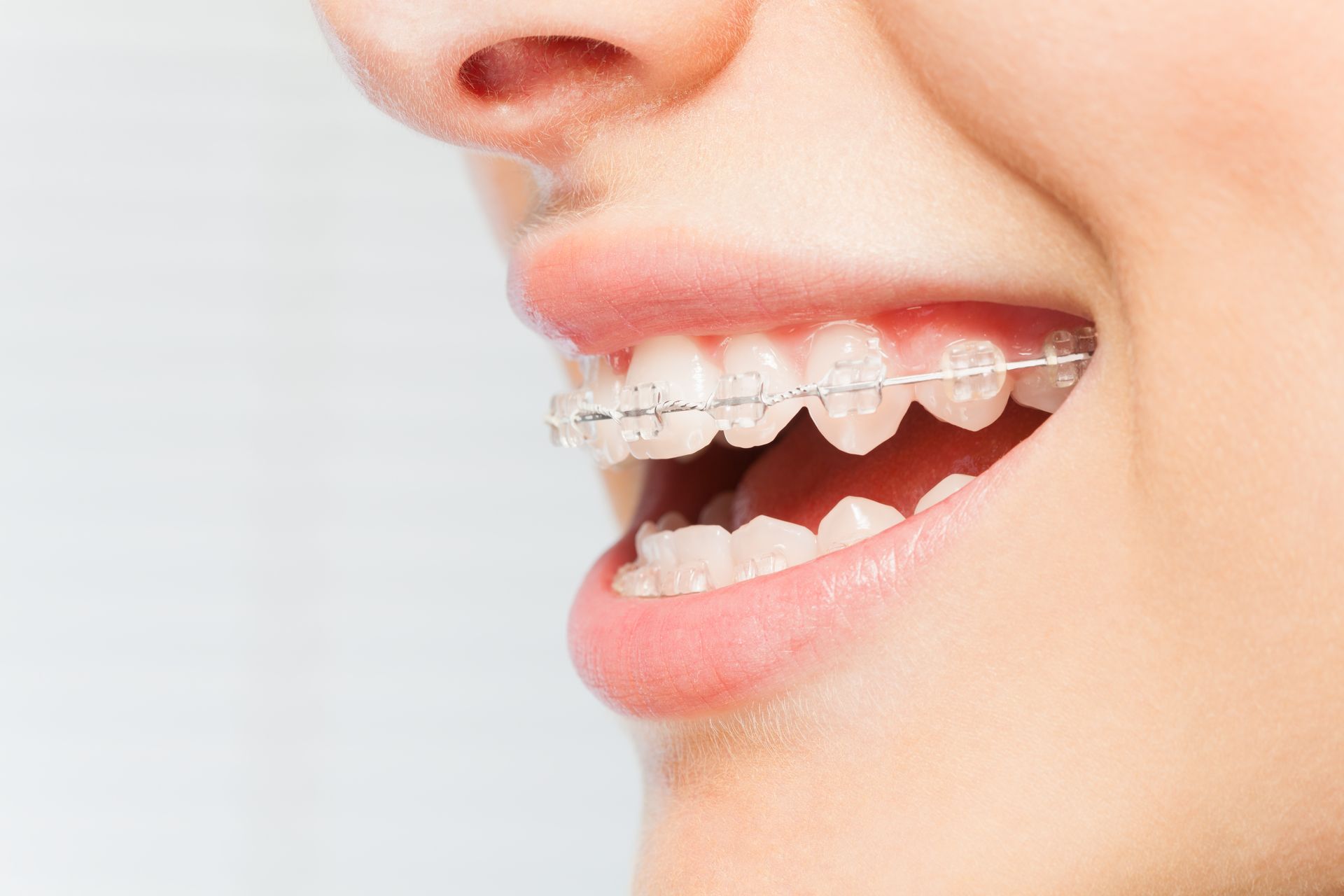 Close-up of a smiling person wearing clear dental braces. Close-up of a smiling person wearing clear dental braces.
