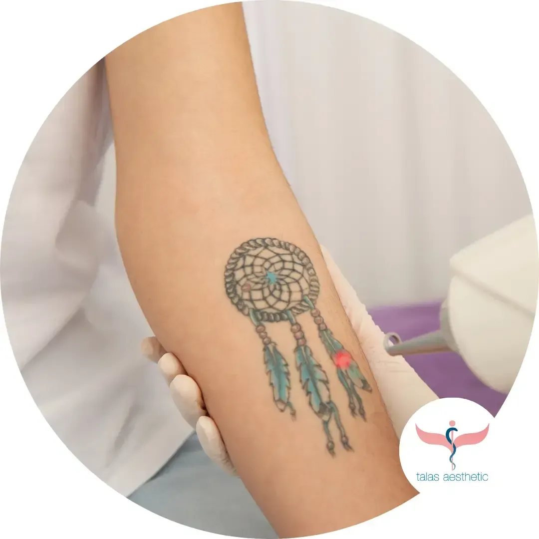 Aufhellung eines Tattoos zur Cover-up Vorbereitung bei talas aesthetic