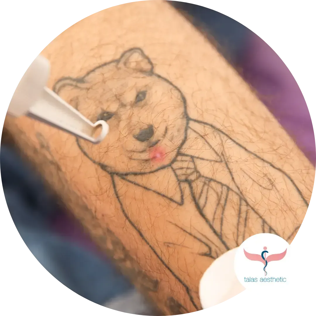 Laserbehandlung zur Tattooentfernung bei talas aesthetic in Eppelheim bei Heidelberg