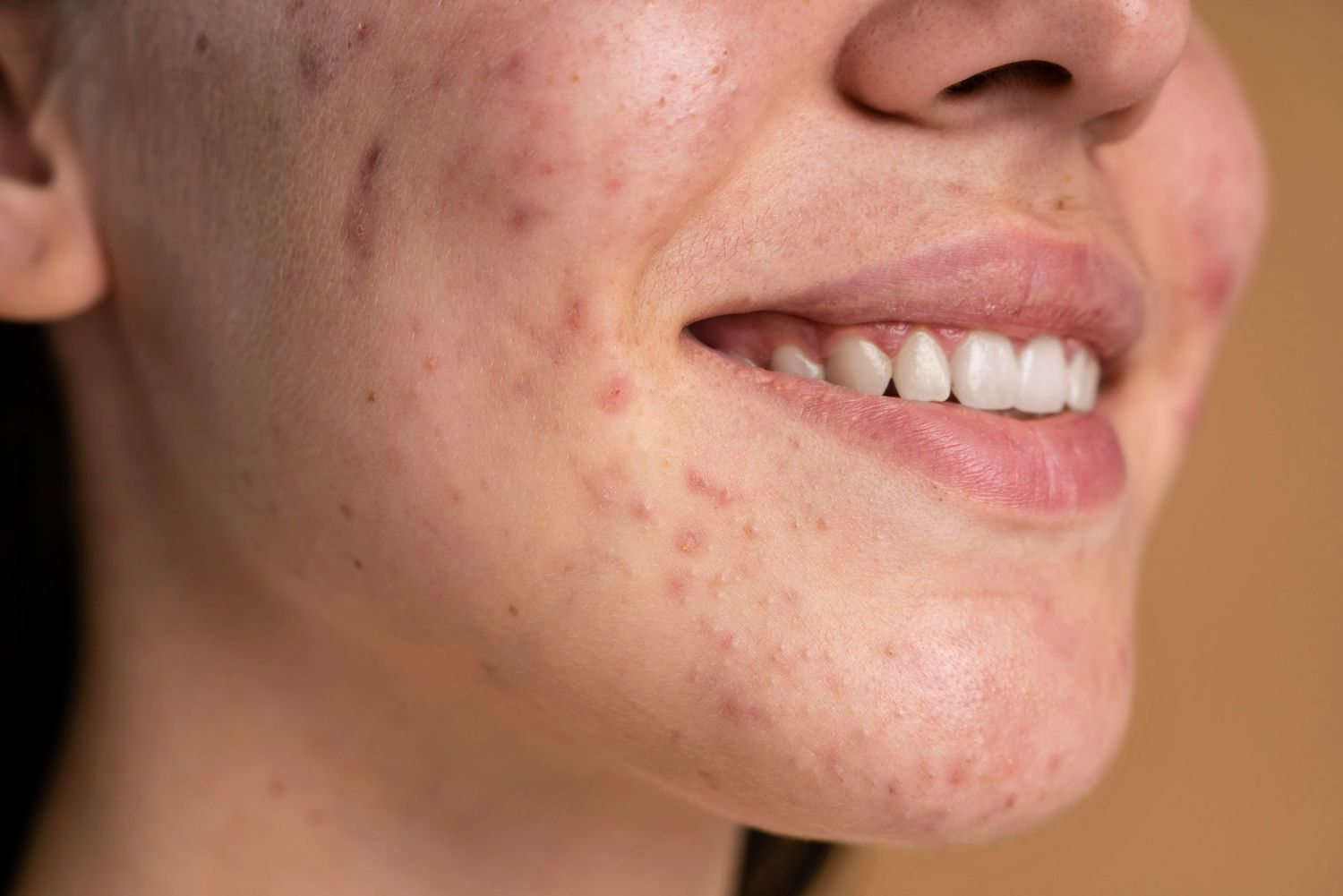 A close up of a woman 's face with acne and white teeth.