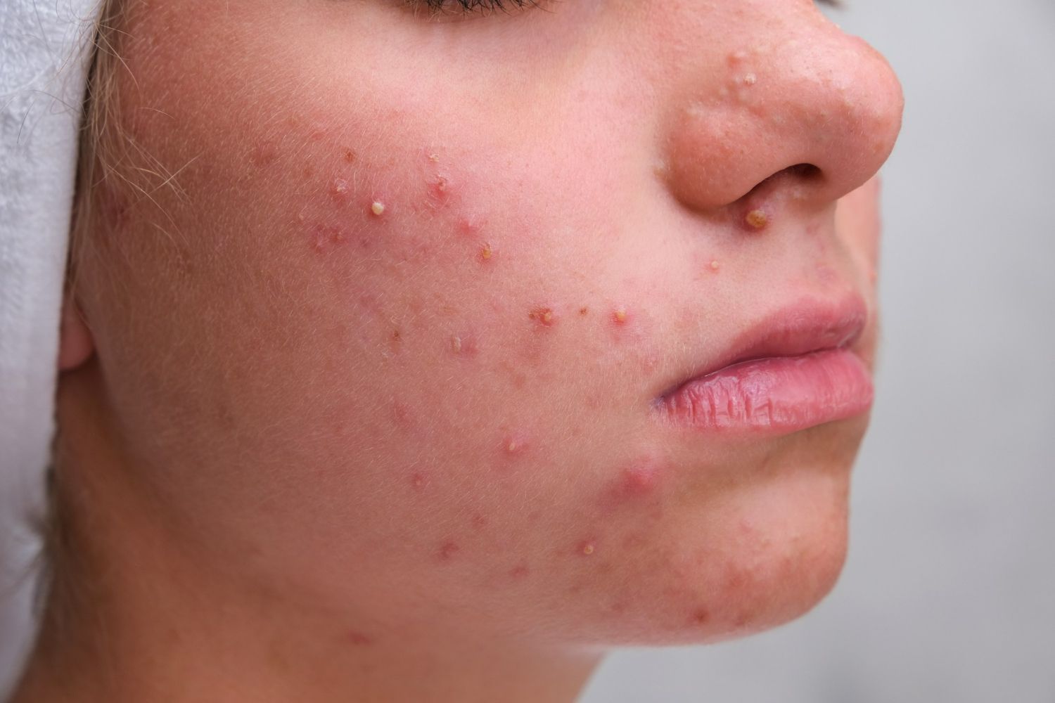 A close up of a woman 's face with acne.