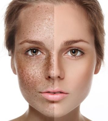 Skin before after treatment