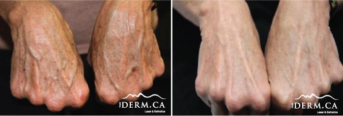 Patient's hands before and after treatment