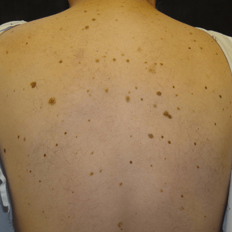 A person's back with moles