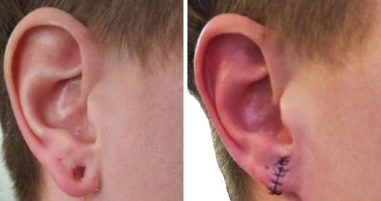 Person before and after earlobe repair