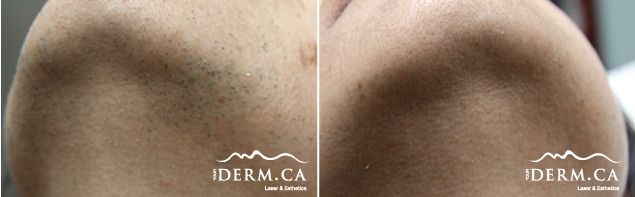 Skin before and after laser hair removal