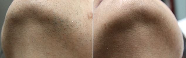 Patient before and after laser hair removal