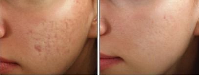 Patient before and after InnoPen treatment