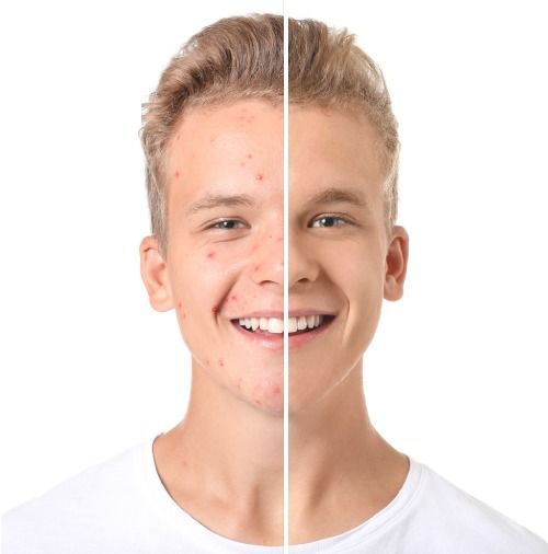 Person before and after Platelet Rich Plasma therapy