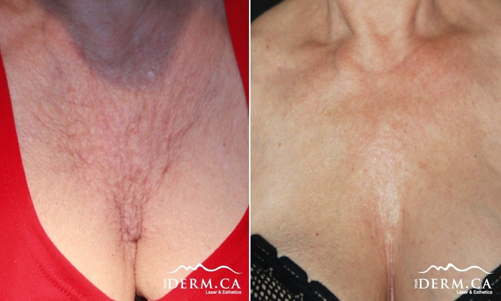 Person before and after Platelet Rich Plasma therapy