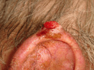 A person with a squamous cell carcinoma tumor on the ear