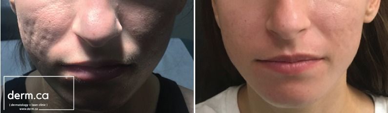 Patient before and after removal of acne scars