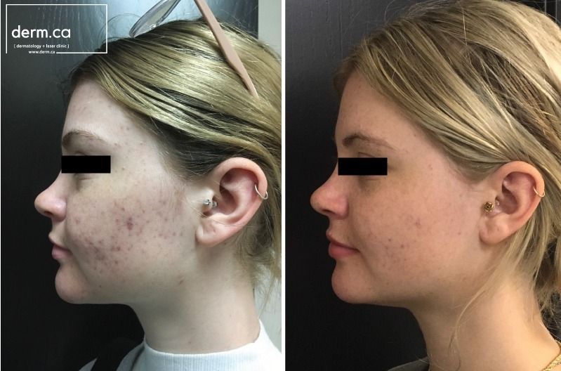 Patient before and after removal of acne scars