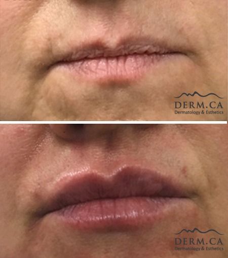 Person before and after Lip Enhancement Injection