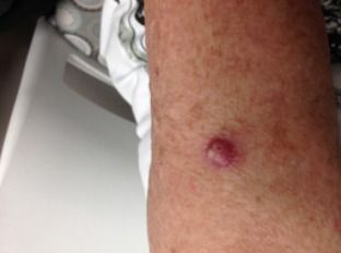 A person with a squamous cell carcinoma tumor on the arm