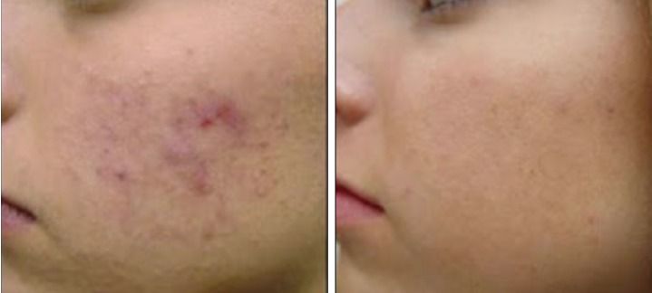 Patient before and after Fractional Laser treatment