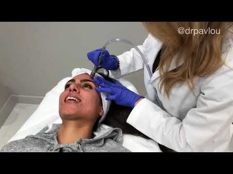 DermaSweep treatment in action