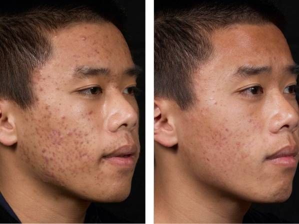 Patient before and after Isolaz laser treatment
