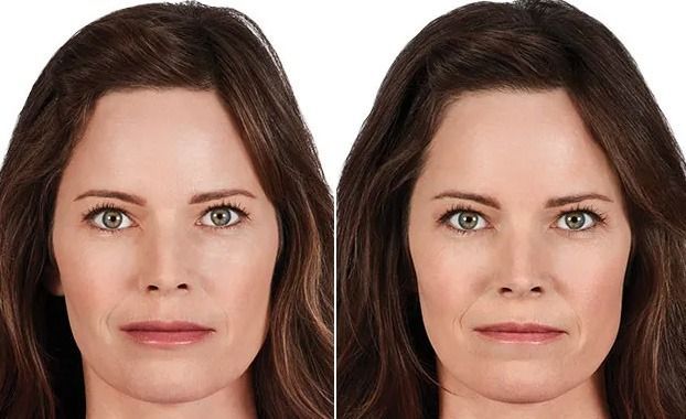 Person before and after Juvederm