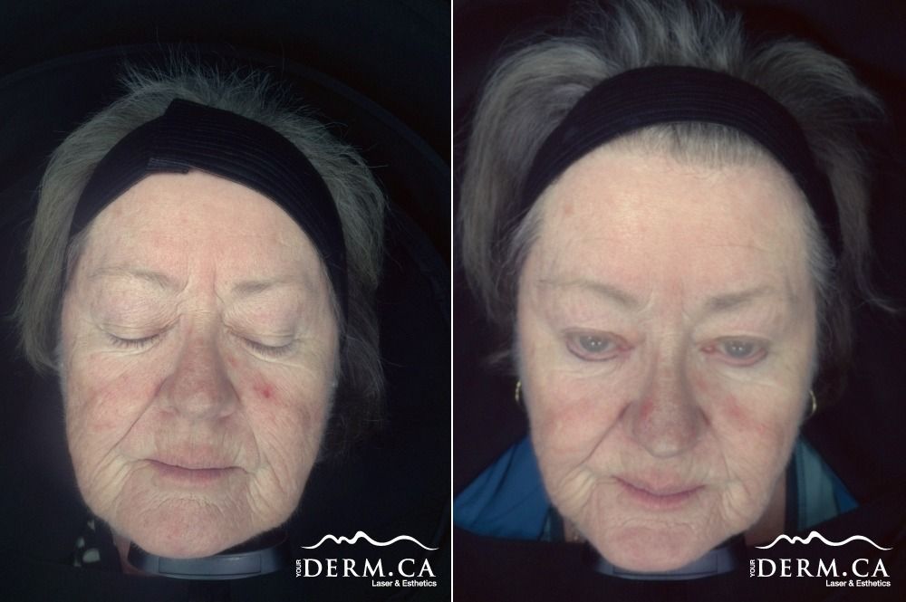 A patient before and after Anti Redness / Rosacea Laser treatment