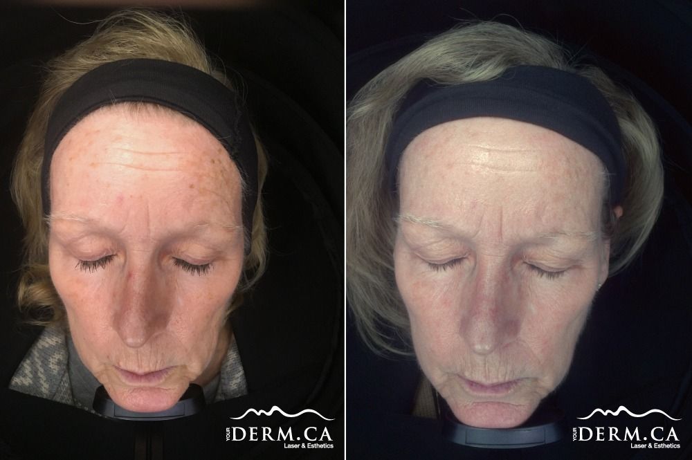 Patient before and after therapies for Melasma