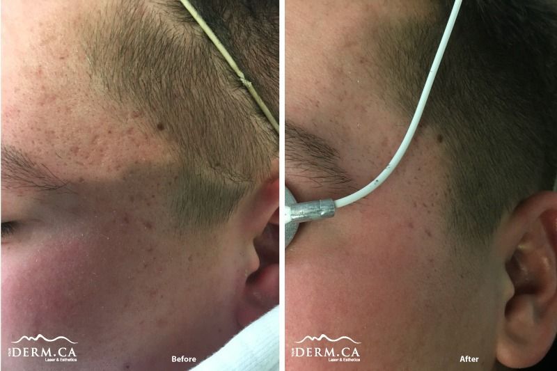 Person before and after Picosure laser treatment