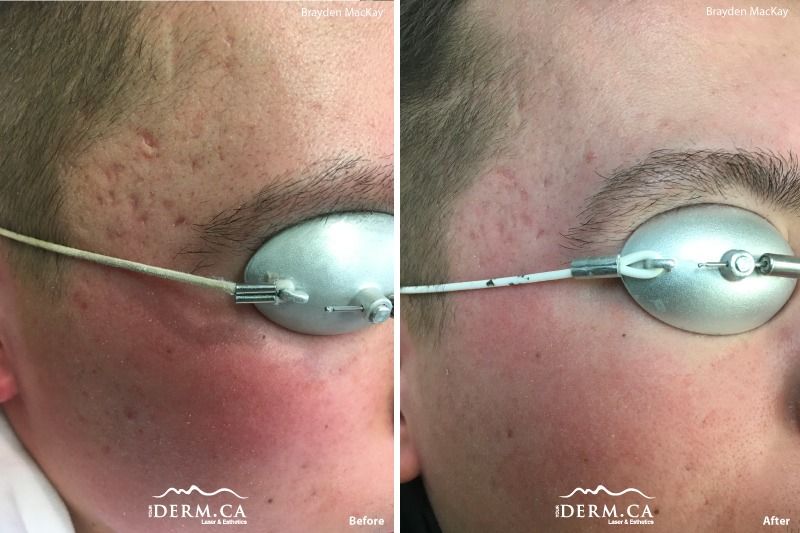 Person before and after Picosure laser treatment