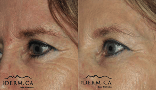 Patient before and after wrinkles removal