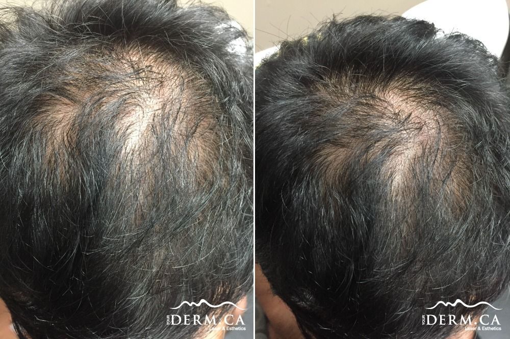 Person before and after PRP Hair Therapy
