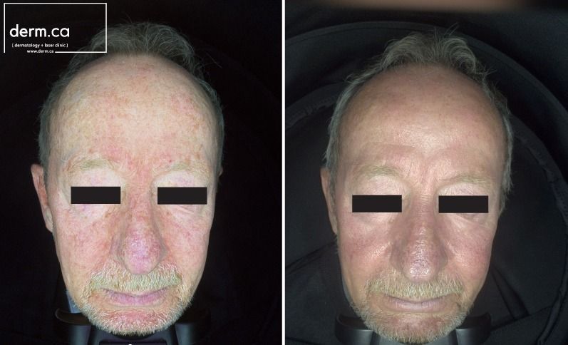 Patient before and after treatment