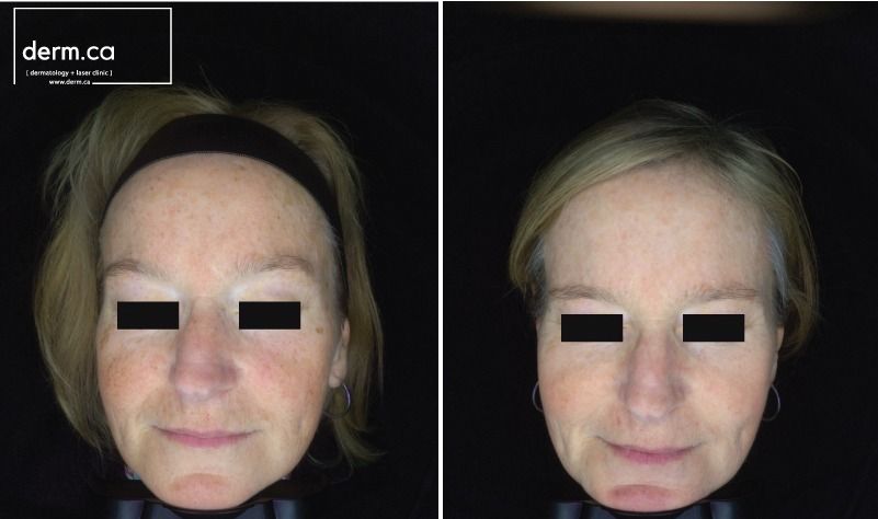 A patient before and after Anti Redness / Rosacea Laser treatment